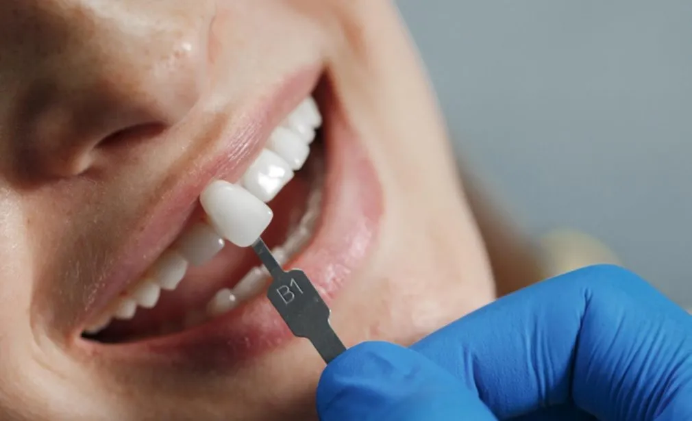 Dental Crowns & Bridges Dubai