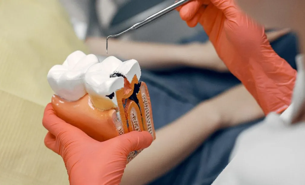Root Canal Treatment Dubai
